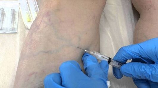 Kadınlarda bacaklardaki varisli damarlar için skleroterapi