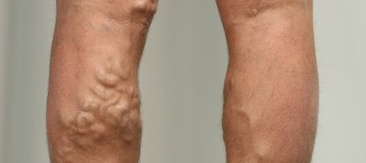 bacakta varisli damarlar