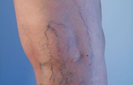 kadınlarda bacaklarda varisli damarlar